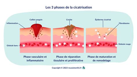 Schéma des différents types de scarification