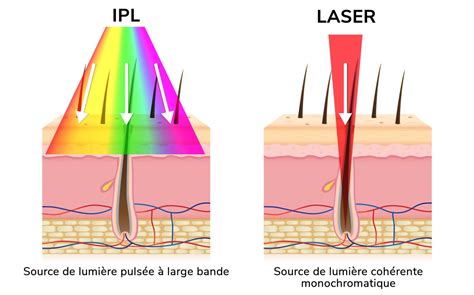 Comparaison visuelle entre épilation laser et lumière pulsée