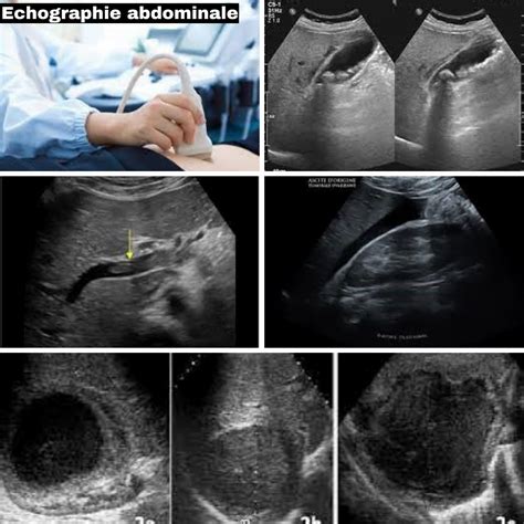 Image échographique montrant le muscle pylorique épaissi (signe de la cocarde)