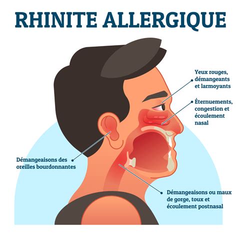 Infographie des symptômes de la rhinite allergique