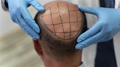 Schéma d'une greffe de cheveux FUE