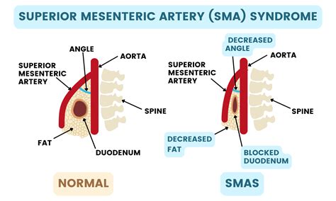 Comparaison SMI vs SMA infographie