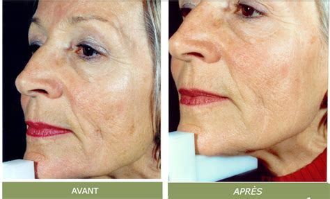 Illustration montrant la coupe de rajeunissement par étapes successives