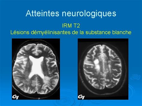 IRM montrant des lésions de la substance blanche temporale