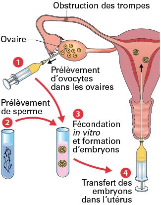 Schéma décisionnel de la procréation médicalement assistée