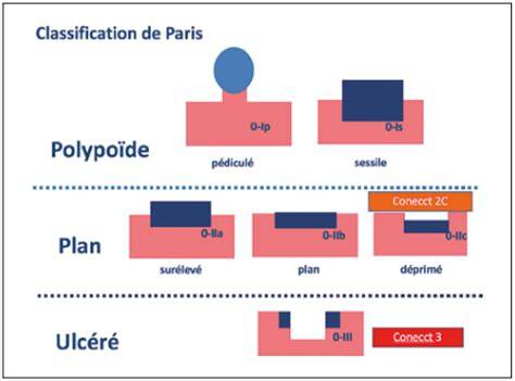 Tableau de classification de Paris des lésions duodénales