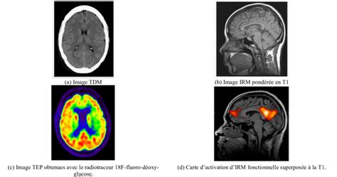 Images d'activation cérébrale détectée par imagerie ultrasonore, montrant l'activité en rouge dans les centres olfactifs