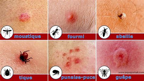 Comparaison microscopique entre une piqûre d'aiguille classique et une percussion Fleur de prunier
