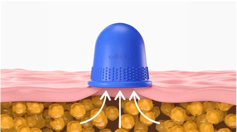 Technique du palper-rouler avec ventouse pour des résultats visibles