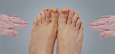 Pieds et mains affectés par une mycose