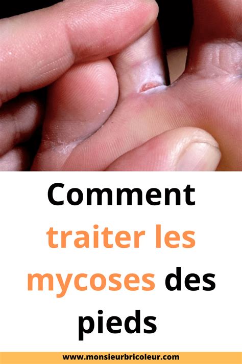 Pied d'athlète entre les orteils