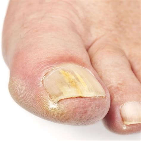 Ongle de pied affecté par l'onychomycose