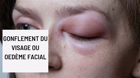 Photo du trique-madame à l'aspect congestionné