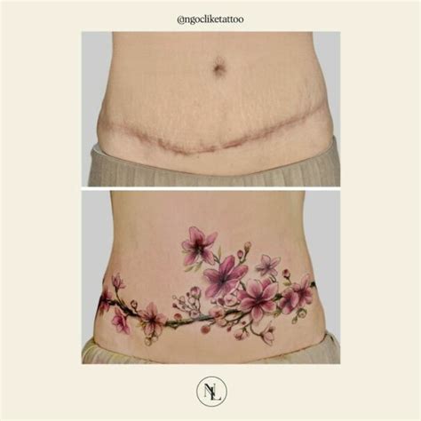 Exemple de tatouage floral intégrant une cicatrice