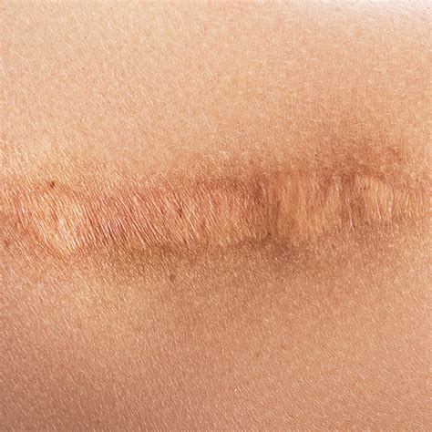 Comparaison avant/après d'une cicatrice camouflée par un tatouage