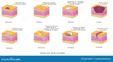 Illustration des différents types de lésions cutanées élémentaires