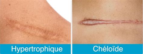 Image illustrant une chéloïde surélevée et irrégulière