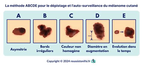 Schéma illustrant la règle ABCDE pour l'évaluation des lésions cutanées suspectes de mélanome