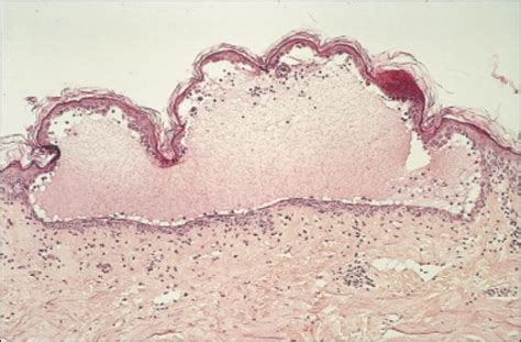 Micrographie d'une bulle intra-épidermique dans le pemphigus