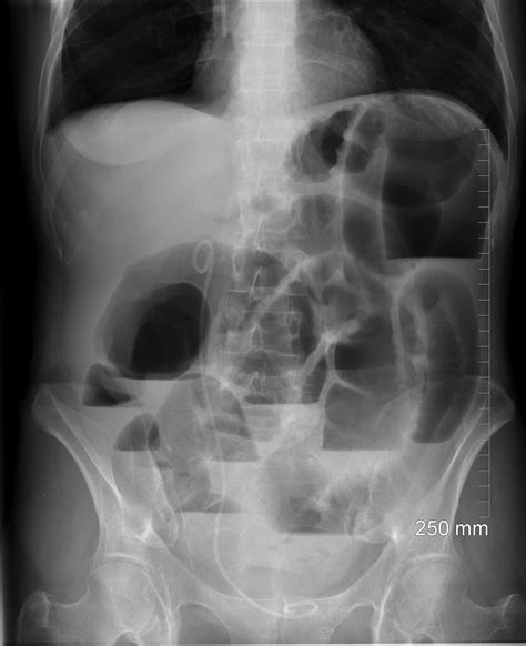 Radiographie d'un gecko léopard avec occlusion intestinale