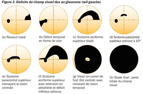 Illustrations des champs visuels pour les catégories B1, B2, B3