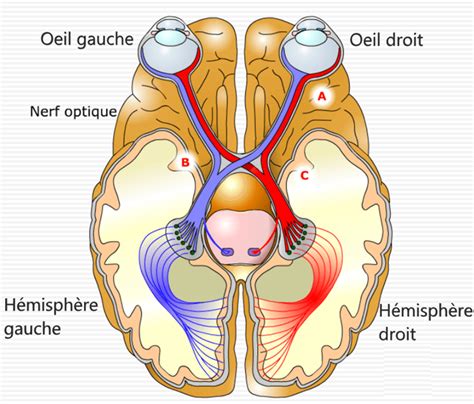 Résultat d'une IRM montrant une inflammation du nerf optique
