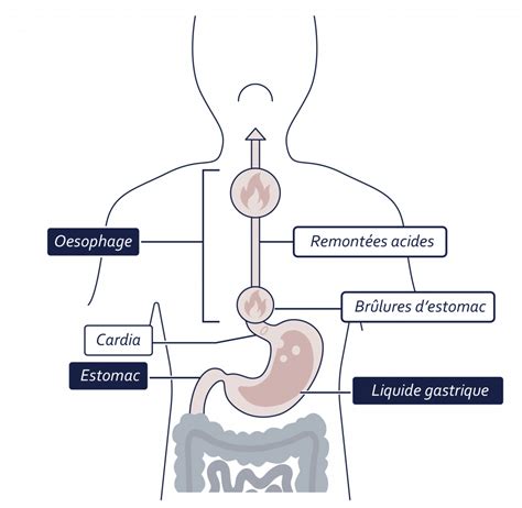 Schéma illustrant le reflux gastro-œsophagien et son impact sur la zone thoracique