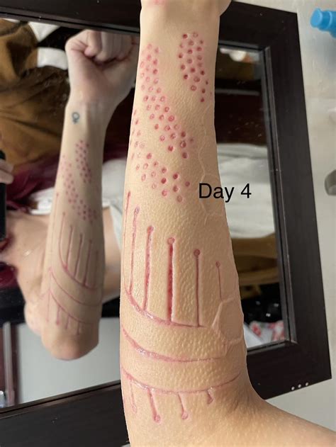 méthode de scarification croisée