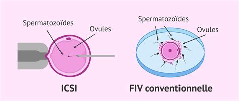 Illustration d'un ovocyte avec un spermatozoïde injecté (ICSI)