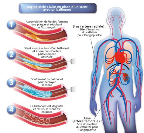 Schéma explicatif de l'effet vasorelaxant de l'hibiscus sur les artères