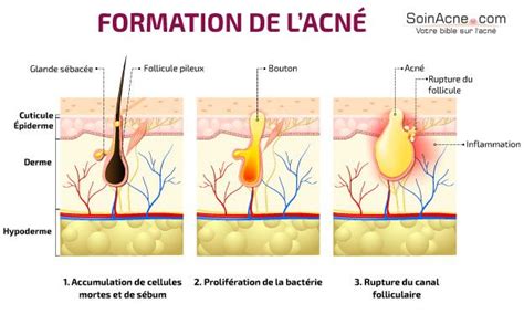 Schéma illustrant la formation de l'acné dans un follicule pileux