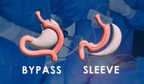 Schéma comparatif entre une coupe bypass et une coupe à enclume
