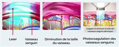 Illustration schématique du traitement laser vasculaire