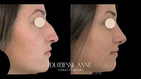 Schéma des zones du nez traitables par rhinoplastie médicale