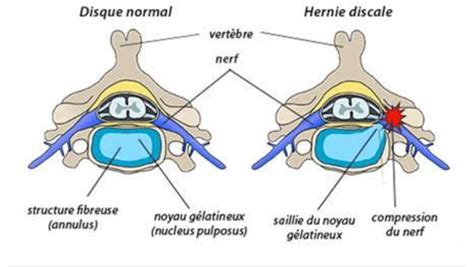 Schéma illustrant une hernie discale comprimant une racine nerveuse