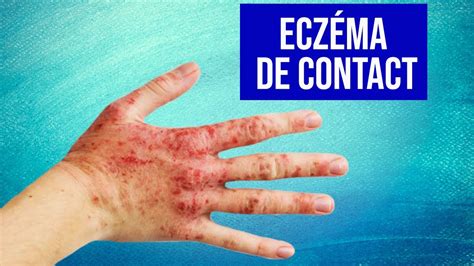 Exemple d'eczéma de contact allergique