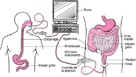 Image d'un endoscope utilisé pour l'examen du tube digestif