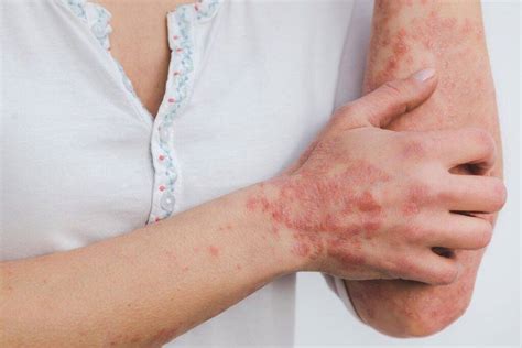 Conditions favorisant les maladies fongiques