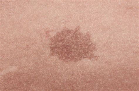 Effets de la tache brune sur la pelouse