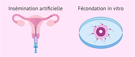 Schéma simplifié du parcours de procréation médicalement assistée