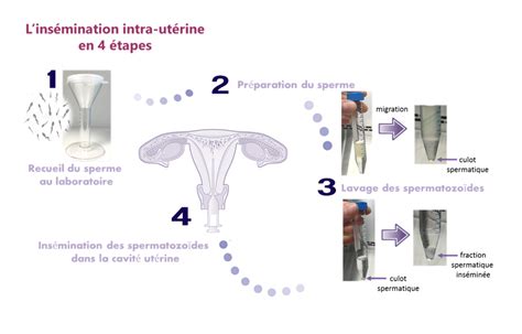 Illustration d'un cathéter utilisé pour l'insémination intra-utérine