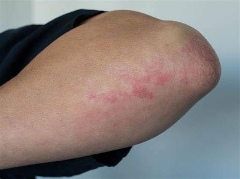 Image montrant les symptômes d'une phytophotodermatite sur la peau