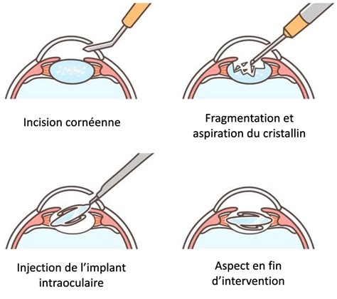 Schéma explicatif d'une chirurgie de la cataracte
