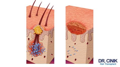 Illustration comparative d'un follicule sain et d'un follicule infecté (folliculite)