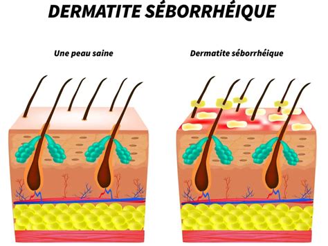 Infographie présentant les différences entre folliculite, dermite séborrhéique et psoriasis