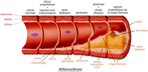 Schéma de la paroi artérielle avec une plaque d'athérosclérose