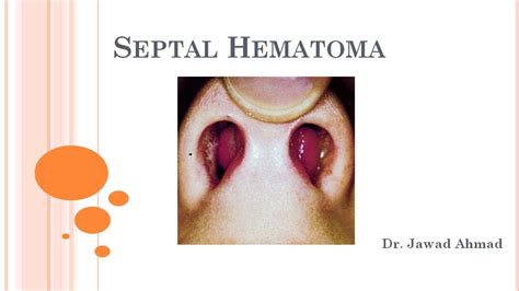 Hématome septal