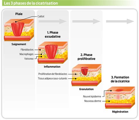 Schéma des différentes étapes de scarification