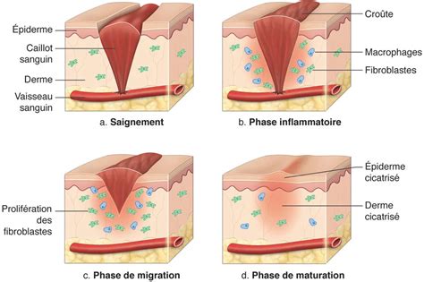 Illustration détaillée de la cicatrisation d'une greffe réussie avec protection