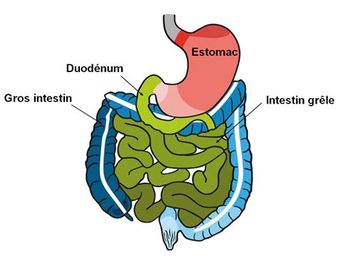 Schéma anatomique de l'estomac et du duodénum avec un ulcère